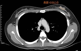 病人經電腦斷層，顯示左乳有2.83公分腫塊，且左腋下淋巴腫大。圖片來源：新竹台大分院腫瘤醫學部
