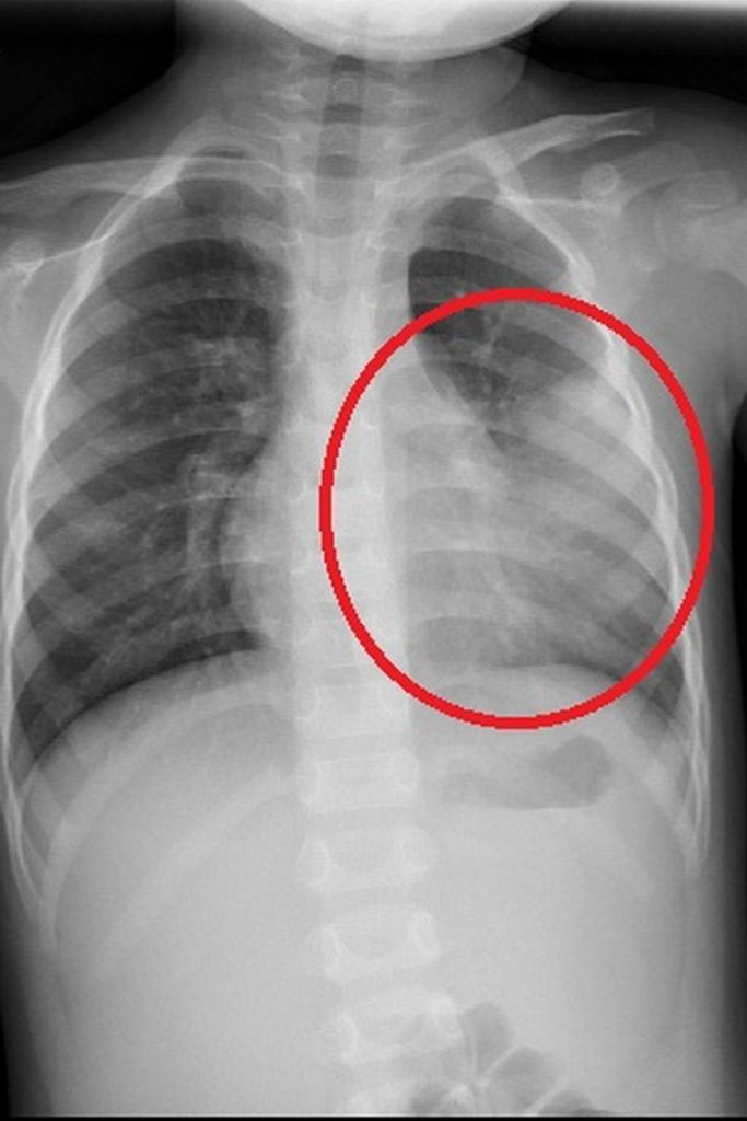 胸部X光檢查顯示，左下肺部出現嚴重大葉性性肺炎。
