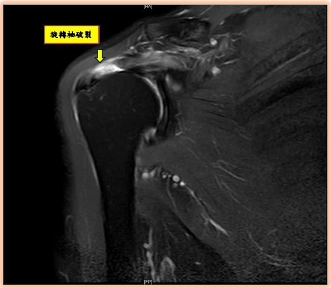 旋轉肌袖破裂常被誤認五十肩